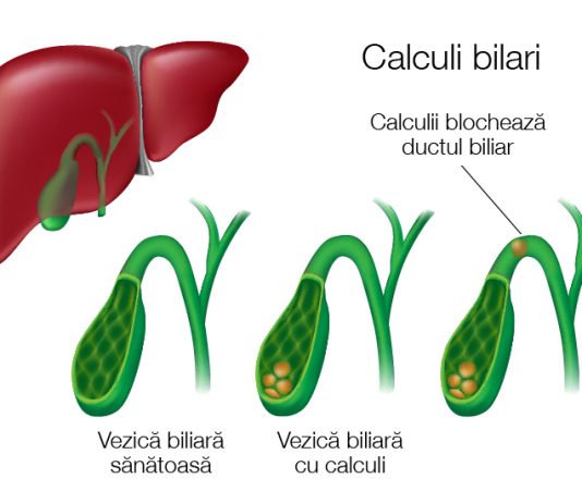 Cum sa spargi calculii biliari in mod natural