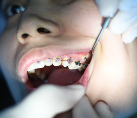 3 sfaturi foarte utile dacă porți aparat dentar